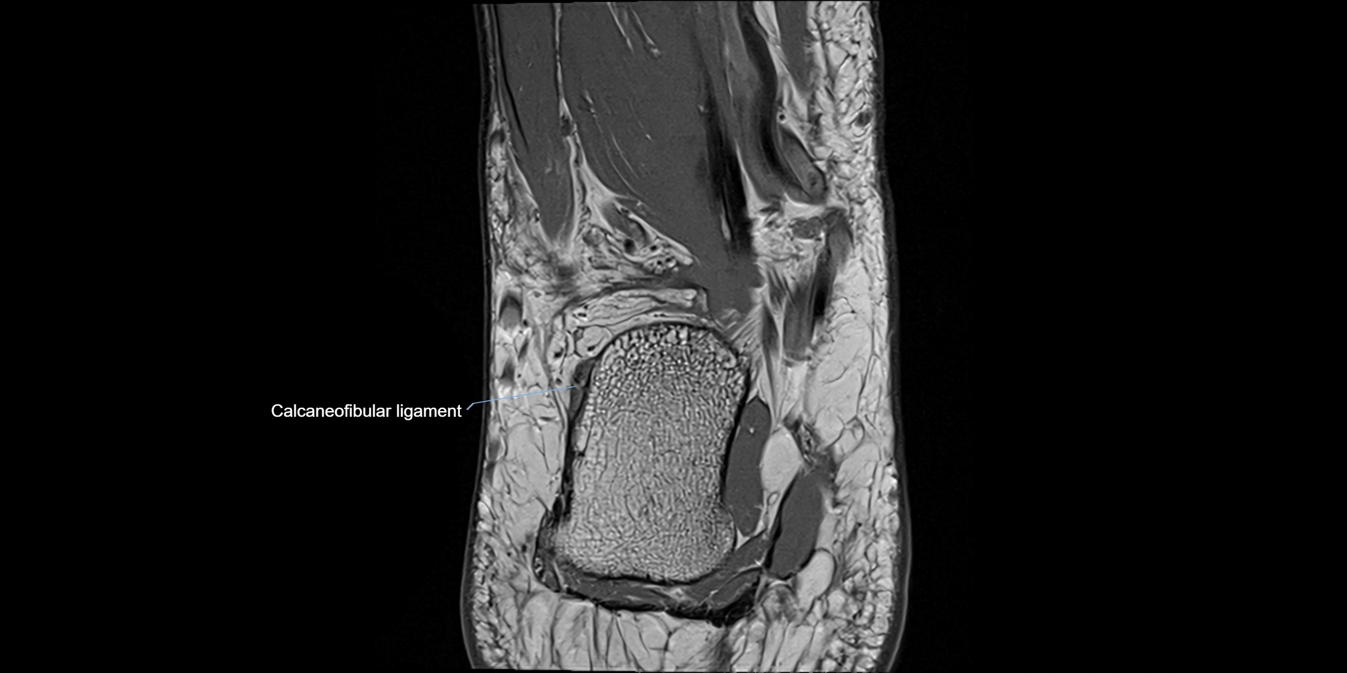 MRI Ankle coronal ligaments cross sectional anatomy 3T  radiology  image-img-00001-00021.webp